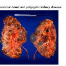 Autosomal dominant polycystic kidney disease 이미지