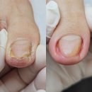 푸스케어수원이든네일 | 수원 망포역 내성발톱 무좀발톱 케어의 첫 시작 푸스케어 만족 후기