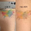 연분홍약국 | 컬러 타투 제거 2회차