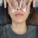 한작대기당구장 | 신사역 피부과 리투오 스킨부스터 1회차 내돈내산 찐 후기 | 일주일 후 효과, 가격, 통증