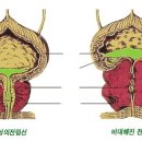 전립선 비대증 치료에 대하여... 이미지