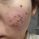 고려한의원 | 내돈내산 수원한의원 여드름 흉터 치료 새살침, 차침 3차 후기