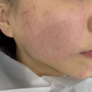 아셀커피 | 청담피부과 스킨부스터 쥬브아셀 맞은 후기 다운타임 통증 효과는?