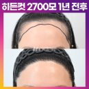 [20대 여자 비대칭 넓은이마 M자헤어라인 머리심기] 비절개 히든컷 모발이식 2700모 1년 후기 (모엠의원/헤어라인/전지훈원장) 이미지