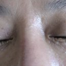 한관종(syringoma) CO2 laser 치료 이미지