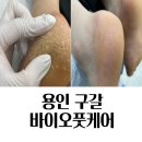 용인내성발톱 바이오풋케어 발각질 제거 리얼 후기