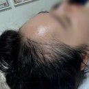 역삼역헤어라인문신 미작뷰티 강남본점 솔직후기 자연스러운 헤어라인 채우기 전후비교