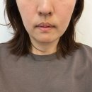 미사리프팅관리ㅣ피부더빛나 하이푸 리프팅 솔직 후기