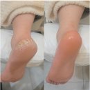 레푸스 | 잠실 여자 발각질 제거 전문점 레푸스 방문 후기