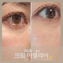 밝은중앙약국 | 아젤리아 크림 여드름 홍조 효과 있을까? 아젤라산 기전 가격 사용법 한 달 후기