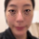 눈 밑 그림자 제거 성공, 눈 밑 지방재배치+지방이식 한 달 반 후기