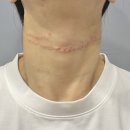 고고성형외과의원 | 강남 신논현 플레저성형외과에서 목주름필러 1cc 뉴라미스 후기