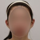 미인동안의원 | 소이의원 귀필러 재시술 / 귀필러 실패 사례 / 귀필러부작용/귀필러재시술