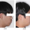 고운미소치과의원 | 저희아들 입이 예뻐졌어요. 안양교정치과 서울고운미소치과 교정후기