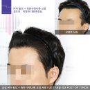 서울항앤하지외과의원 | 모앤라인│20대 초반 M자 탈모, 런던 유학생이 선택한 모발이식 2주 변화는?