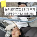 코샵성형외과의원 | 윗 눈꺼풀 처짐, 엑소젠 시술로 리프팅 받은 후기