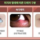 눈다래끼 약 초기 원인 증상 아시나요 이미지