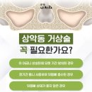 정DENTAL | 팔용동치과 상악동 거상술 꼭 필요할까요?