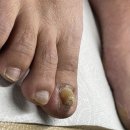 엔피케어창원 | 창원 내성발톱 아팠다가 관리받고 좋아진 후기