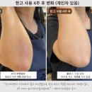 눈에띄다 | 팔꿈치건선 피부건선연고로 관리한 남해건선 후기3명