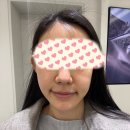 영의원 | 팔자주름 고민 끝! 영영영의원 쥬베룩 3회차 내돈내산 솔직 후기🥸