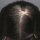 대도 초등학교 | 도곡동탈모병원 남성 탈모치료 후기｜여러 병원 다닌 뒤 느낀 차이