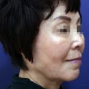 리뉴미피부과의원 네이버블로그