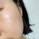 아밍 뷰티 | 원 데이 필 3주 후 후기 < 아밍뷰티 >