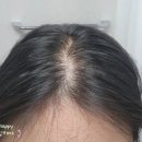 코리아병원 | 모발볼륨 초기탈모 관리 방법 후기 병원샴푸 브랜드 볼빅 미토코리아 탈모앰플