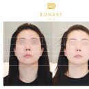 씨유 분당이매점 | 분당안면비대칭 교정 잘하는곳 보나트페이스 분당점 다녀왔어요(1회차 후기)