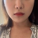 논현조은약국 | 신논현역 올리지오 조은날의원 리프팅 받은 후기