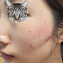 땅콩PC | 내돈내산 수원 피부과 / 땅콩형 얼굴, 광대축소레이저 솔직후기 2차