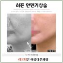 강남거상술병원추천 / 최소절개안면거상술 / 안면거상술유지기간 / 거상술회복기간 / 거상술잘하는곳 / 이미지