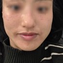 레이지1주안 | 굴포천 기미잡티 피코토닝 3회 ~ 5회 솔직후기 화장품값 굳었음