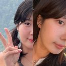 압구정 피부과 소멸핏 피팅레이저 얼굴형 관리 후기