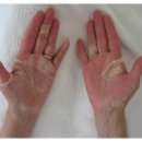 항암 치료과 관련된 수족증후군 (hand-foot syndrome) 이미지