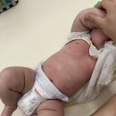 나아짐 | 아기 동전습진 아토피 원인 | 동전습진 아기 피부 나아진 후기(세제 바꾸니까 나아짐?)