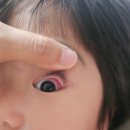 아기 눈 책에 찍혀서 서초 바른빛안과 다녀온 후기 ㅠㅜ 유아 안과 대추천