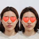 산한의원 | [강남안면비대칭] 턱소리·눈높이 차이 고민으로 다녀온 안면비대칭한의원 찐 내돈내산 후기!