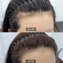 소답제2 경로당 | 창원 78아트 : 창원 두피문신 SMP 자연스럽게 잘하는 곳 헤어라인 교정 찐만족 후기 (전후 비교)