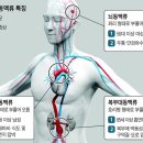 뇌동맥류는 두통·복시, 복부는 박동성 혹 만져지면 의심 이미지