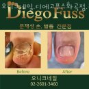 오니크네일 이미지
