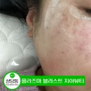 대구 주근깨 제거 플라즈마블라스트 지아뷰티 후기