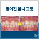 언제나이든치과의원 | 나비 모양으로 벌어진 아이 앞니 교정 사례 성남 교정 치과