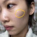 셀릭 | 청담피부과 커스텀 BBL 기미제거 레이저 리쥬셀릭 재생크림 후기