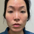 스킨영의원 | [강남역피부과] 스킨부스터 연어주사+엑셀V홍조레이저+제네시스 레이저 시술 후기