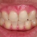 백상치과의원 | 2년 반 부정교합 2급 성인 치아교정 후기, 통증, 고통, 전후 차이