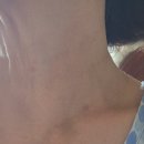 [목주름관리] 가로목주름 필러 벨르넥 레이저 후기 - 삼성역피부과 벨르넥