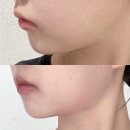 부천중동피부과 슈링크 솔직후기