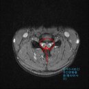 Re:MRI판독 및 소견입니다. 이미지